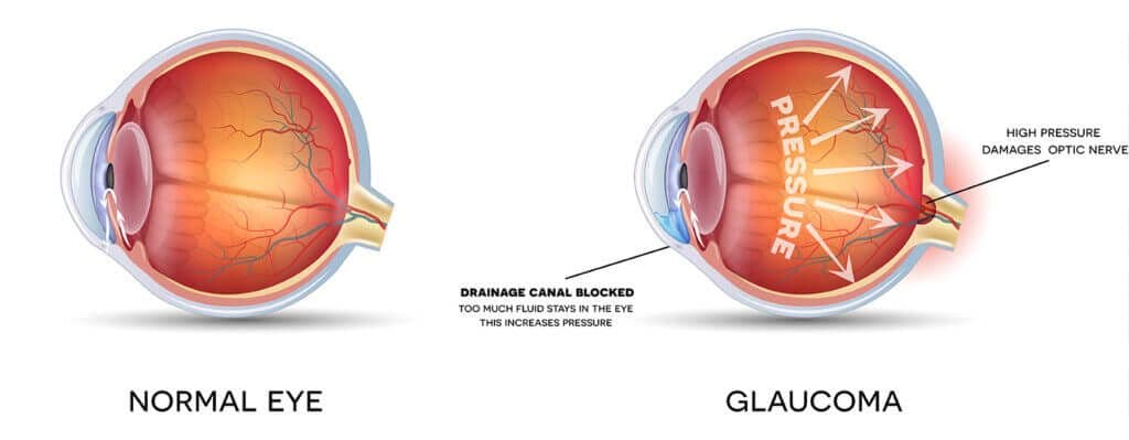 What is Glaucoma?